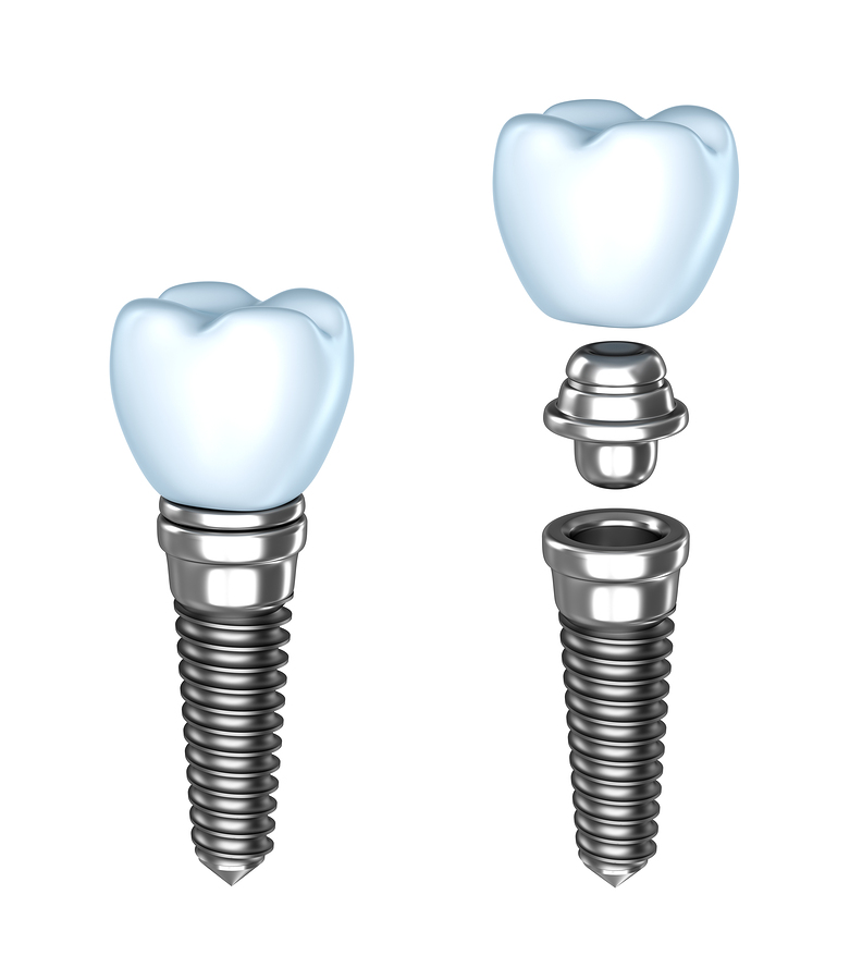 assembly of dental implant Beeville, TX
